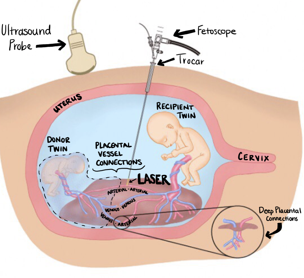 Fetoscopic Laser Ablation - Edited by me, click for original source from Japan Fetal Therapy Group