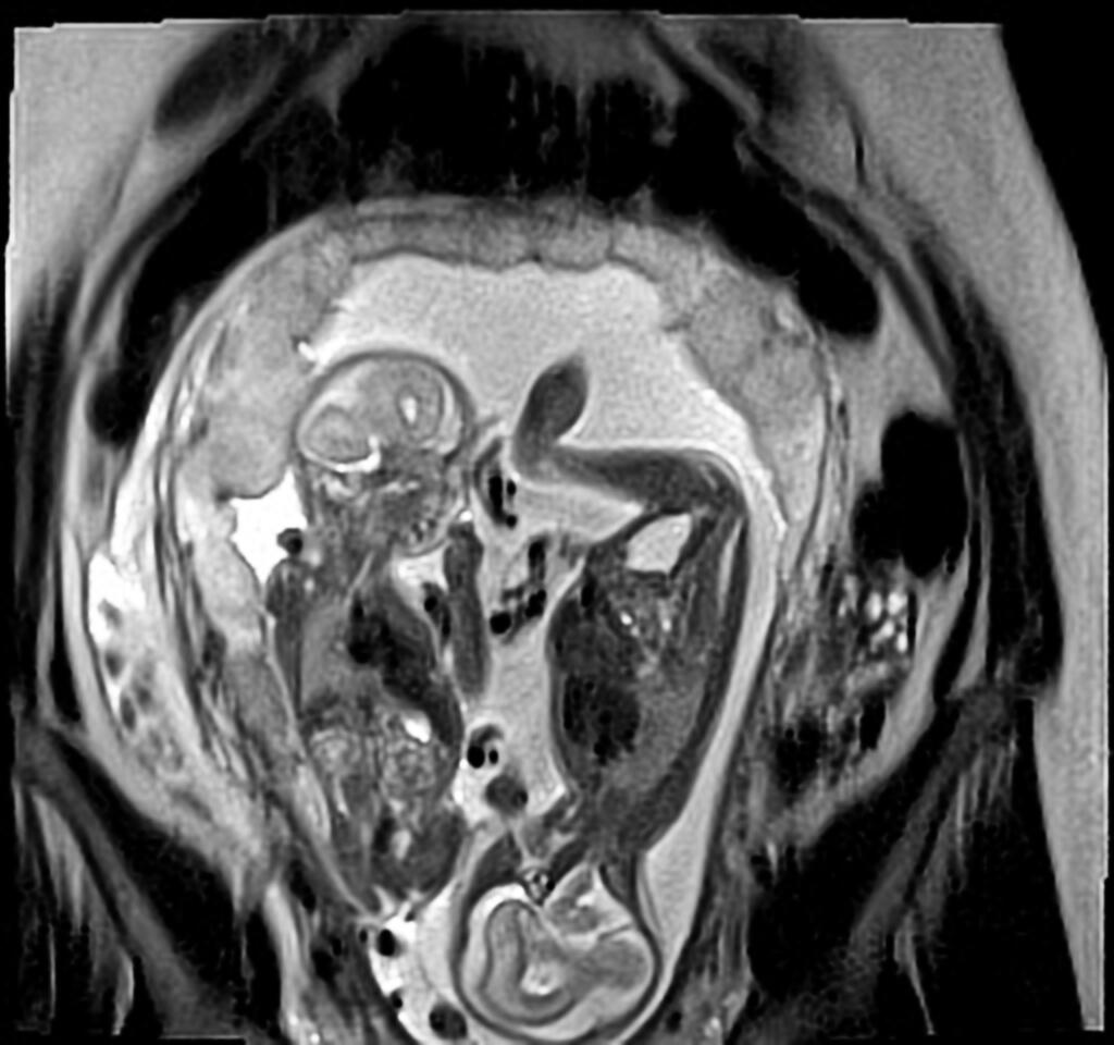 Case courtesy of Dr Alexandra Stanislavsky, Radiopaedia.org. From the case rID: 51114