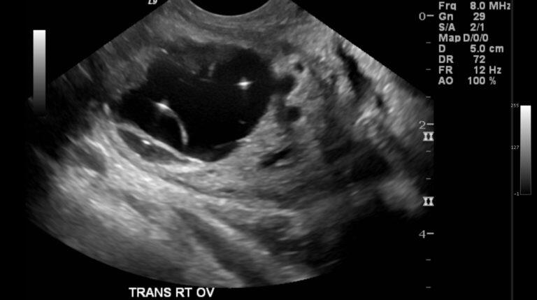 hair and teeth in cyst